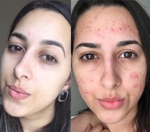 THE ORDINARY Niacinamida + Hialurónico + Salicilico