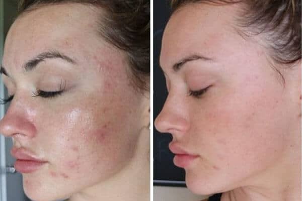 THE ORDINARY Niacinamida + Hialurónico + Salicilico