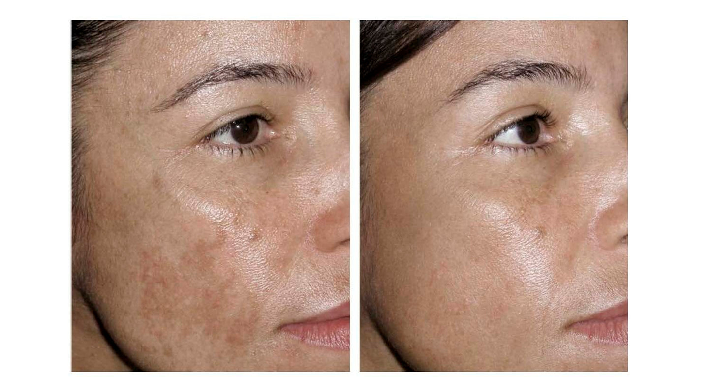 THE ORDINARY Niacinamida + Hialurónico + Salicilico