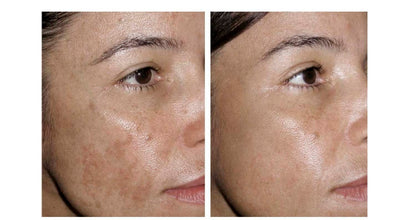 THE ORDINARY Niacinamida + Hialurónico + Salicilico